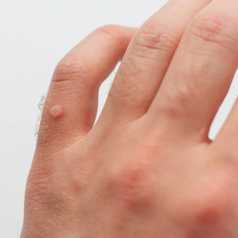 Warzen entfernen behandeln